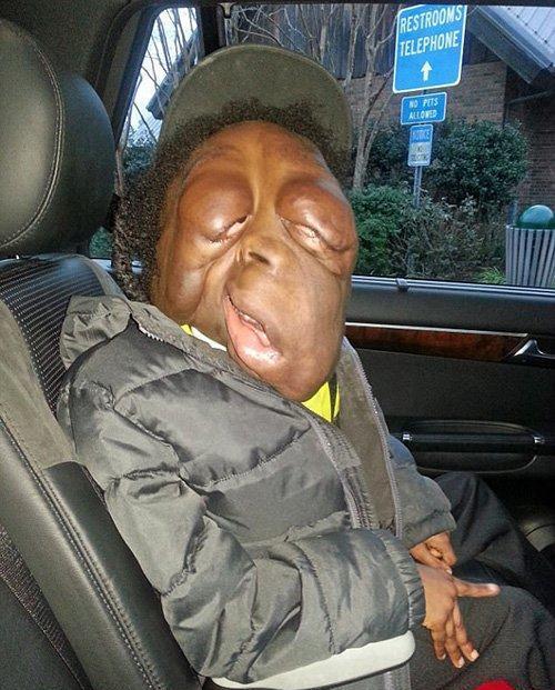 8岁童患罕病脸严重变形 妈妈: 比病痛更让人难过的是嘲笑