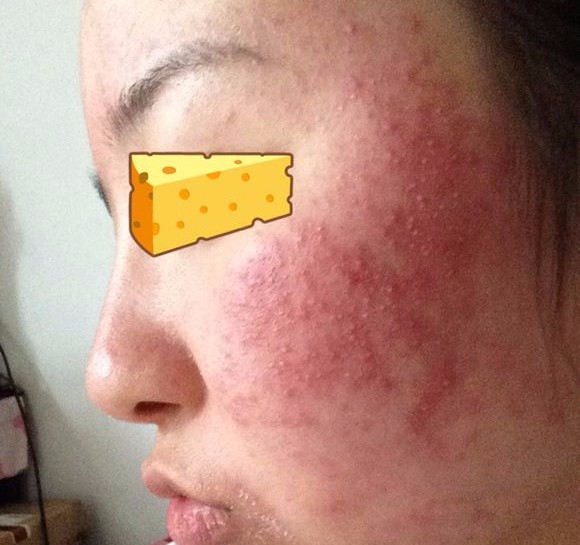 脸上发红发痒起皮干燥怎么回事?会不会是激素