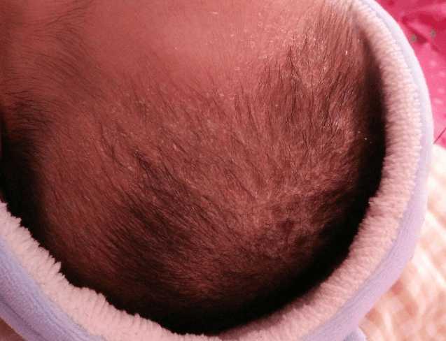 通过这件事情希望家长一定要引以为戒,头垢这种东西每个小孩都有,但