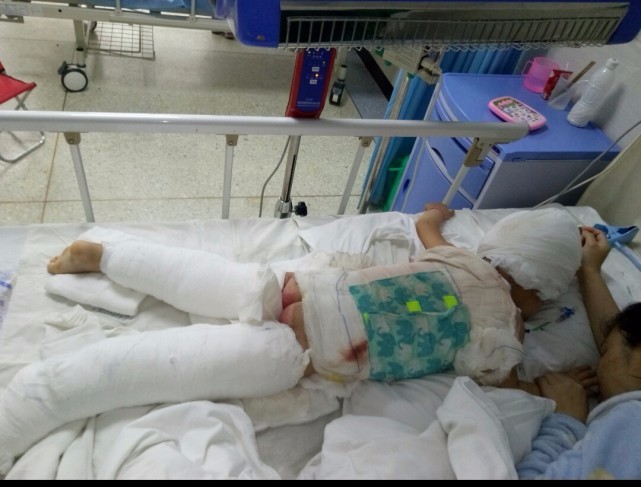 郴州留守娃被烧成木乃伊爷爷自责怕见孙女