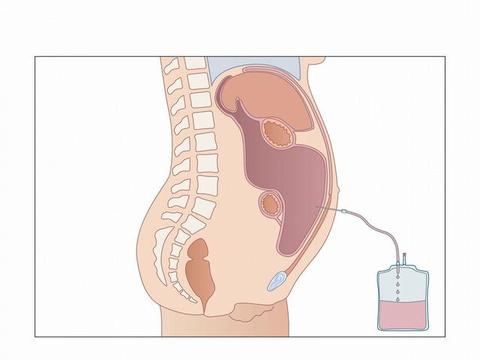 恶性腹水,癌症常见表现,腹腔穿刺排液是最好的办法吗?