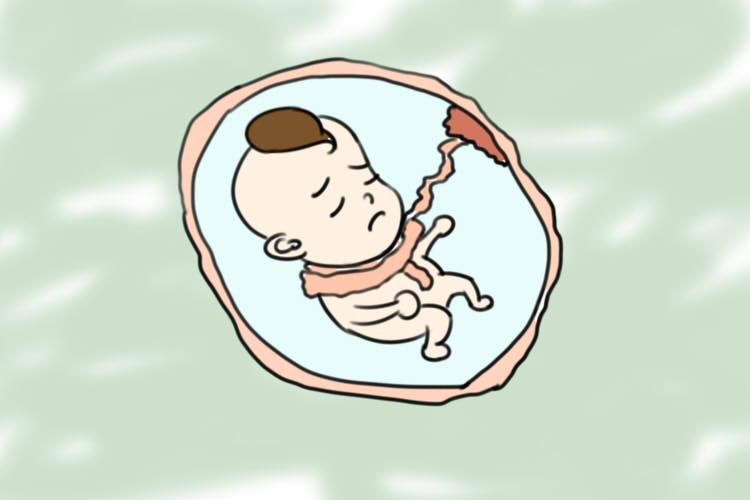 脐带扭转, 孕27周小公主离开我了, 孕期出现这种异常要及时就医