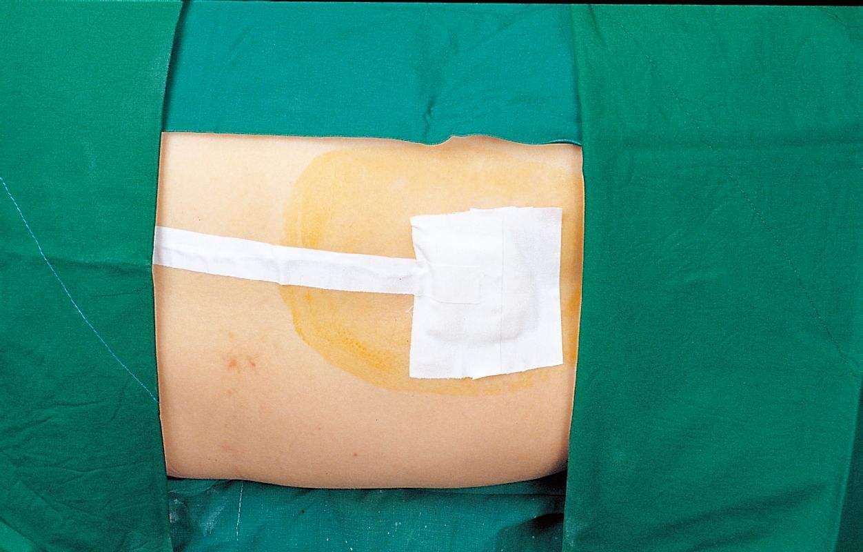 都知道无痛分娩不疼, 那么这一针得花多少钱?