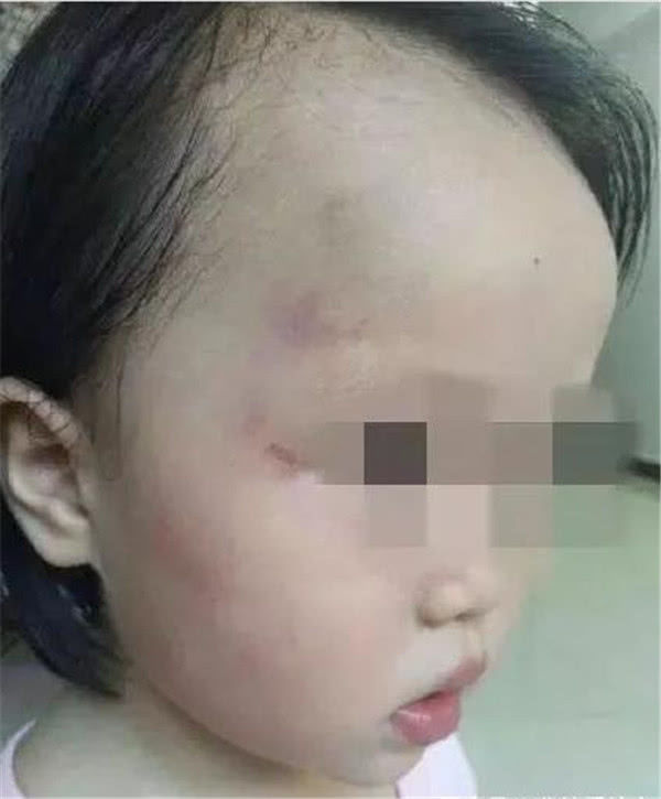 2岁女童在幼儿园屡次被打伤打人老师给出理由网友还是人吗