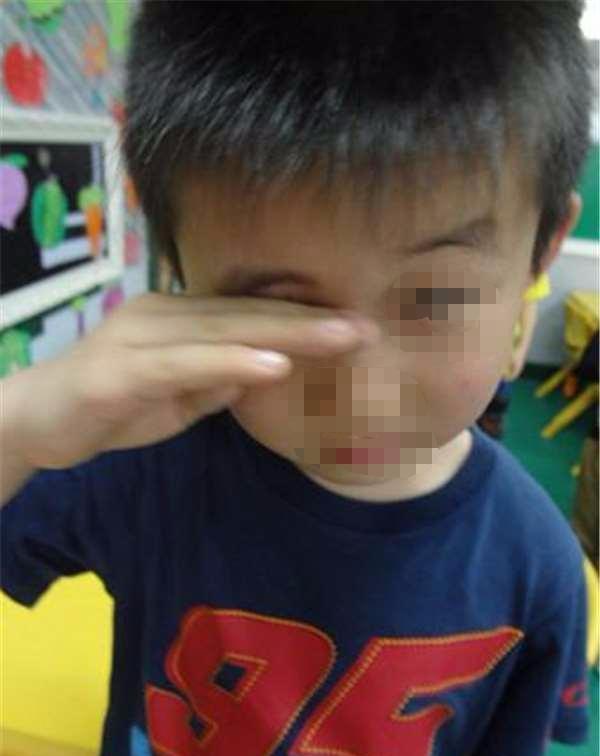 5岁小男孩因吃零食造成右眼"失明", 零食暗藏着巨大的危险?