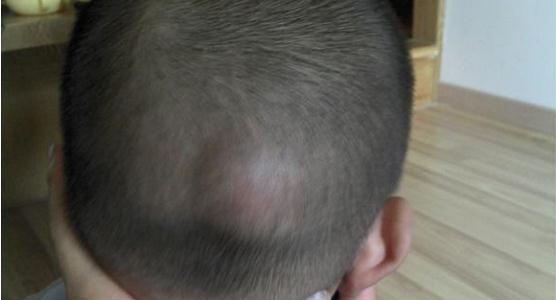 正文            检查后发现,女儿的后脑勺居然有一个大包,幸好情况不