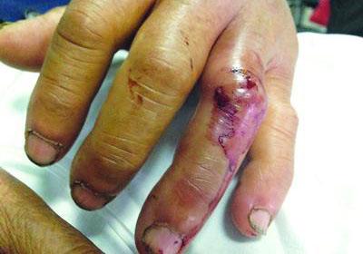 年轻女子为捞手机伸手进马桶却被老鼠咬伤该如何处理呢