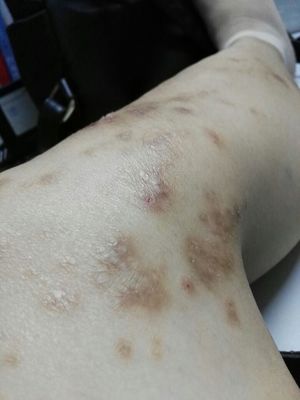 首都皮肤科专家:每天坚持用"它" 3天湿疹消失了!
