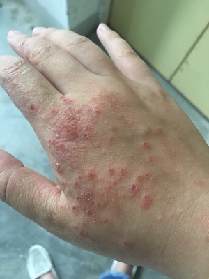 首都皮肤科专家:每天坚持用"它" 3天湿疹消失了!|湿疹|皮肤科|皮肤_新