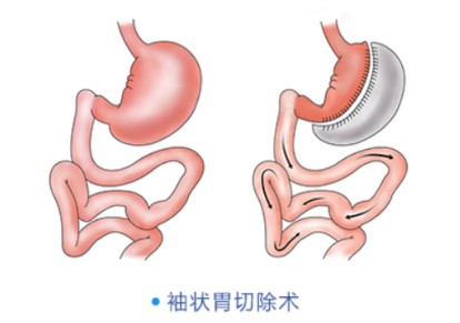 肥胖糖病人切胃手術多少錢?