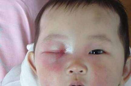 2岁男孩右眼失明,因在饭桌上玩它,很多孩子还在玩,家长小心了