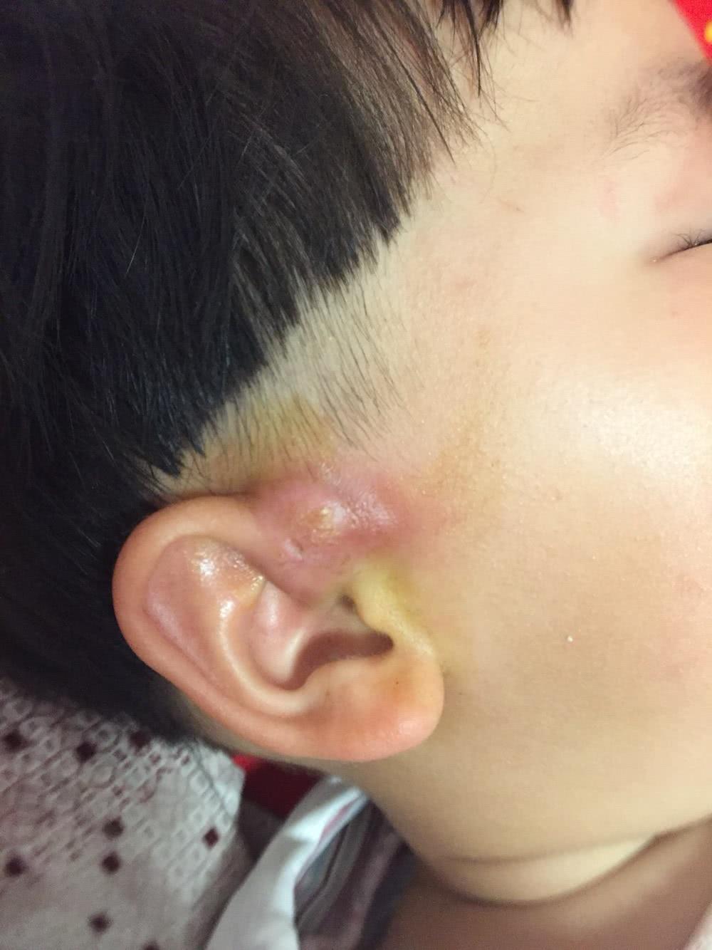 妈妈们别再以为孩子耳朵旁的针眼状小孔是所谓的聪明孔了