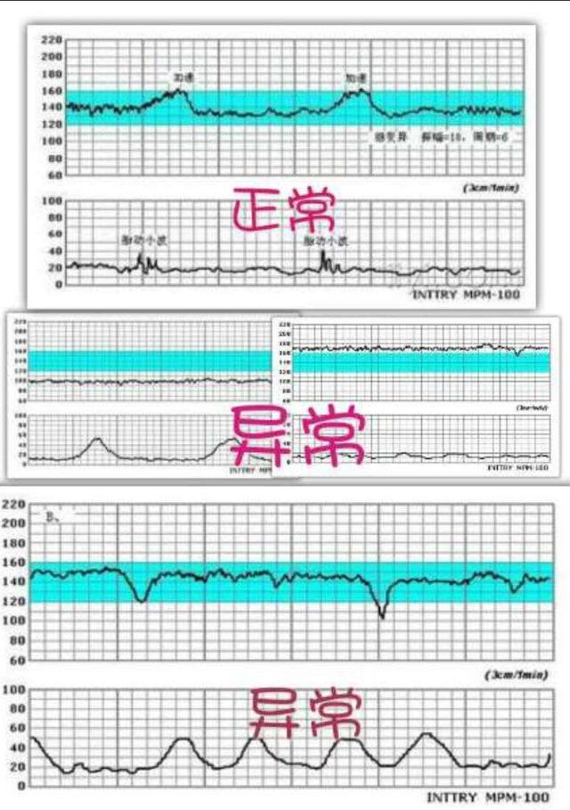 关于胎心监护你知道多少掌握这些知识就不用担心啦