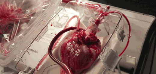 英国医生: 10年内, 心脏移植或被人工泵和干细胞疗法取代