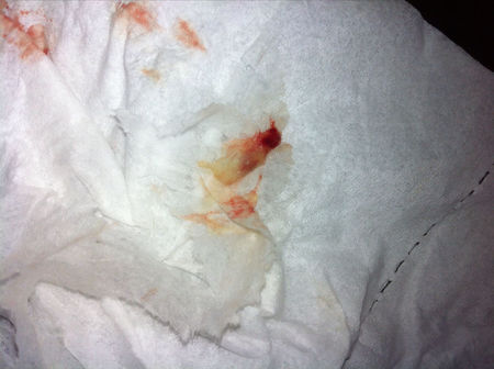 2,鼻出血;常打喷嚏后流出少量鼻血或鼻涕带血丝.