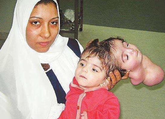 罕见的连体婴儿,其中一个只有脑袋没有四肢,手术成功分离