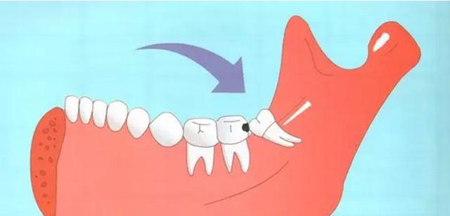 智齿该拔吗？是不是平时多注意一点就没事了？