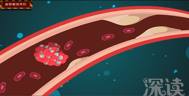 这爆血管的地方如果在大脑,那就是脑溢血;如果在眼睛,那就是眼底出血