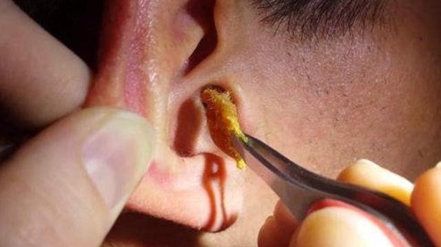 耳屎堵在外耳道正常吗?