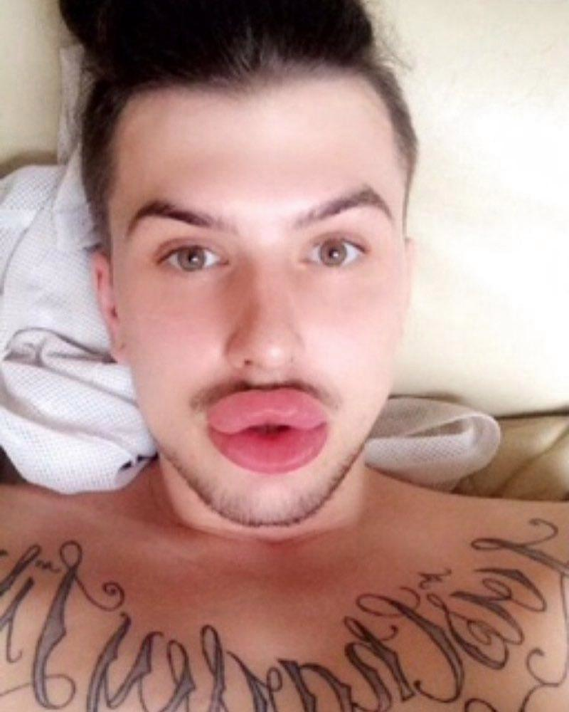 凯莉詹娜以香肠唇闻名男粉丝为了模仿金小妹整成这个样子