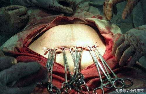 男人们来看看女人剖腹产用的麻醉针头有多粗生孩子所受的痛