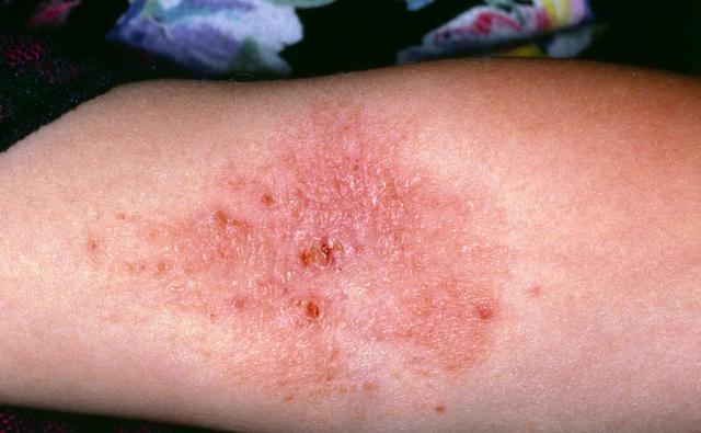 5岁男孩得严重湿疹生日愿望妈求求你让我快点死去吧