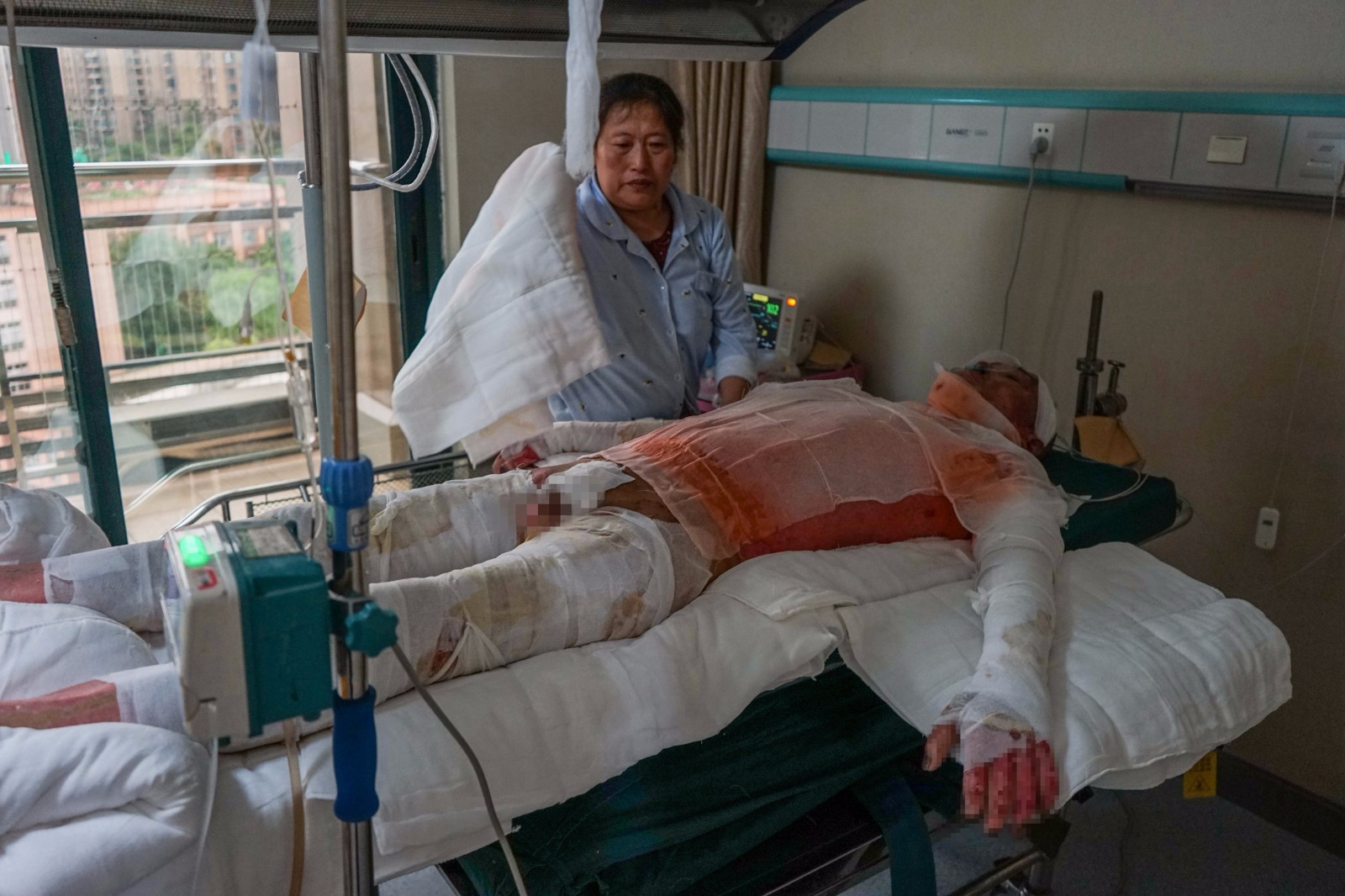 10岁娃做早餐引大火,单亲爸火海救女3人重伤,拄拐老太守仨病房