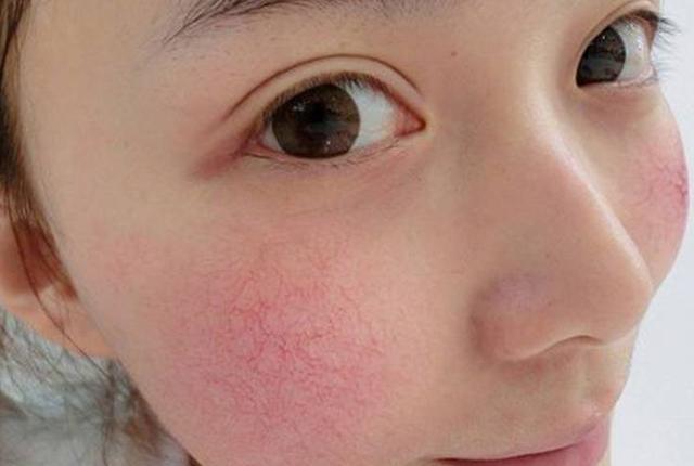 失去角质层保护的脸蛋,出现红血丝,用它才能挽回皮肤保护屏障