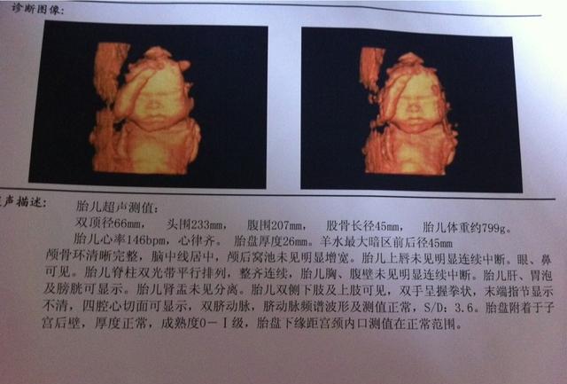 四维大排畸顺利归来, 分享下怀女宝的症状和肚形