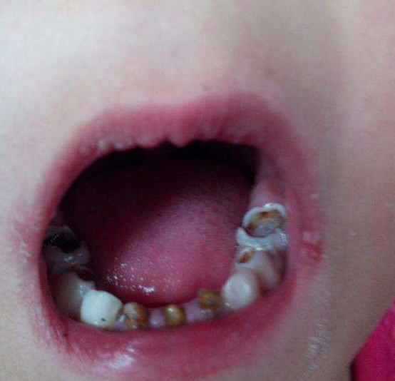 部分家长都不知道这个习惯也会让孩子黑牙,2岁宝宝不吃糖却有一口黑牙