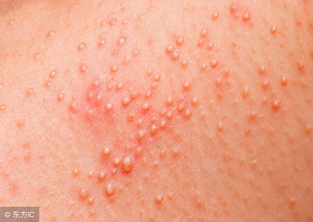 芒果|皮肤炎|皮炎_新浪新闻