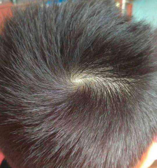 一胎头旋看二胎男女, 生过二胎的宝妈可以看看准不准?