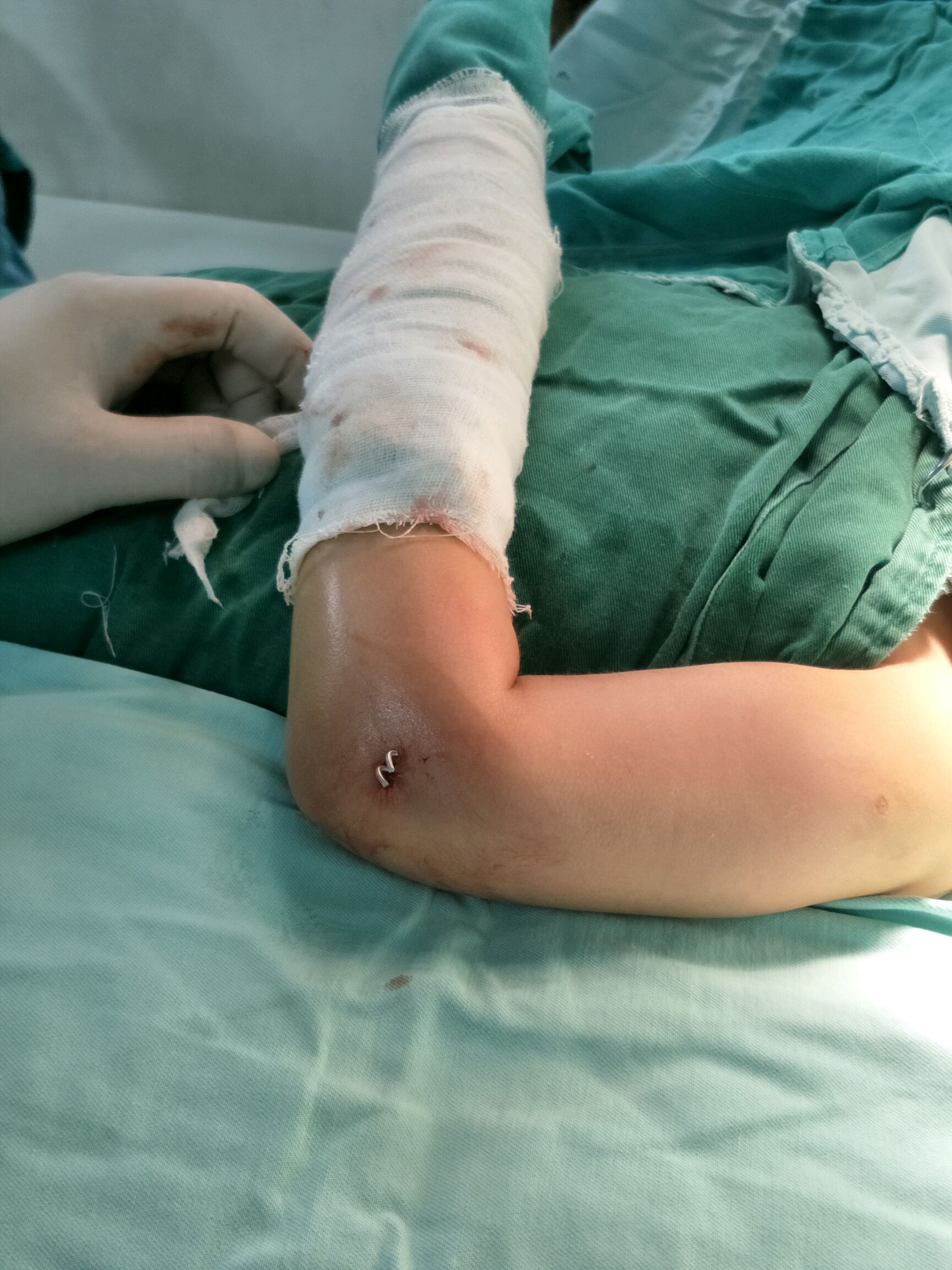 三周后拆掉石膏,同时拔掉克氏针,拔针的时候不用住院,不用麻醉,瞬间