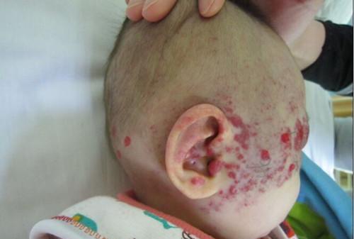 婴儿脸上血管瘤图片图片