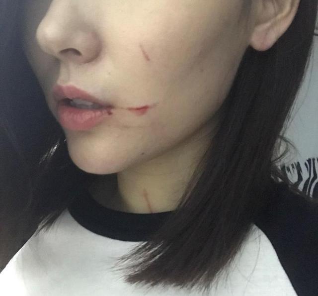 女生打架伤口照片图片