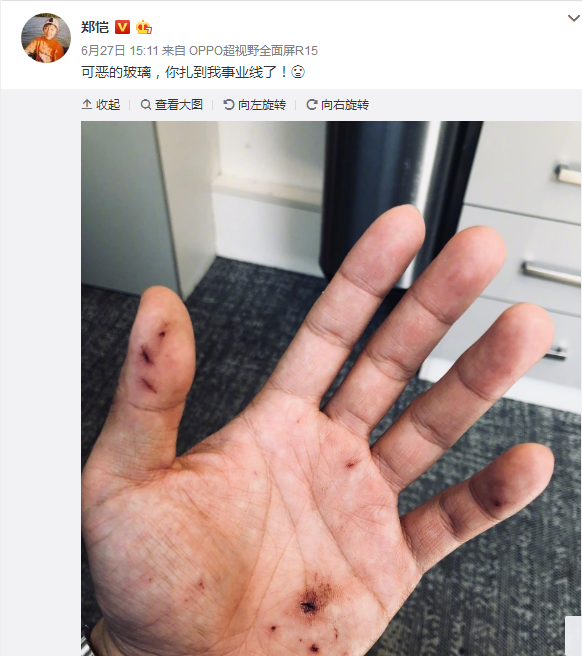 郑恺微博晒出受伤的手,还称晚上睡不着,疑似事业遇到挫折?