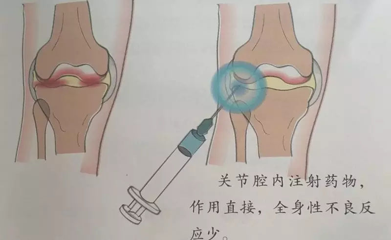 关节腔内药物注射由于骨关节炎的病变发生于关节内,所以关节腔内注射