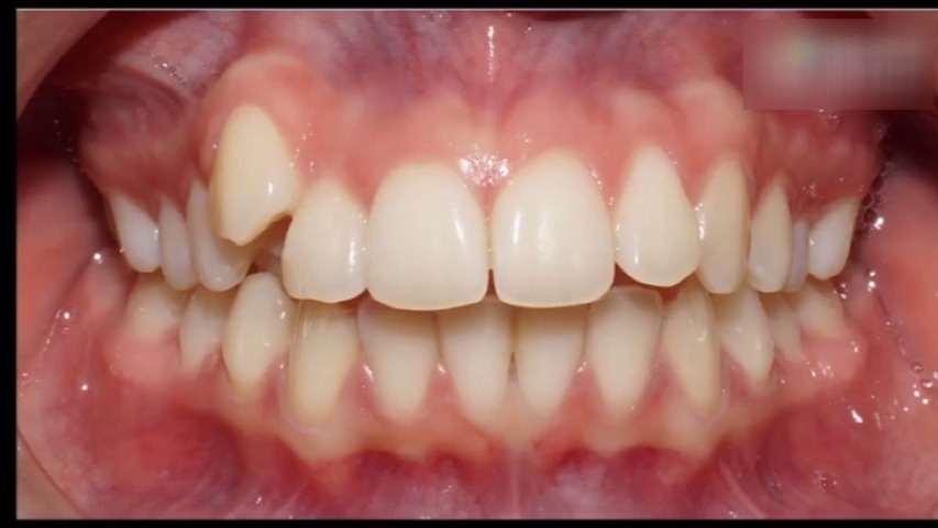 深覆盖是如何矫正的?下面是前牙深覆盖矫正的简单过程!