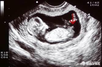 怀孕12周男女区别图图片