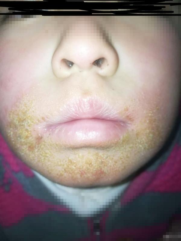 芒果|皮肤炎|皮炎_新浪新闻