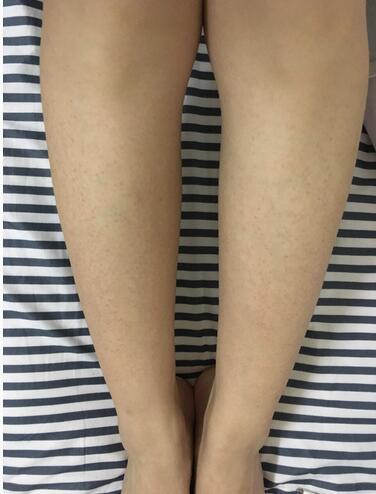 腿上鸡皮肤变成红疙瘩怎么办(腿上鸡皮肤变成红疙瘩怎么办啊)