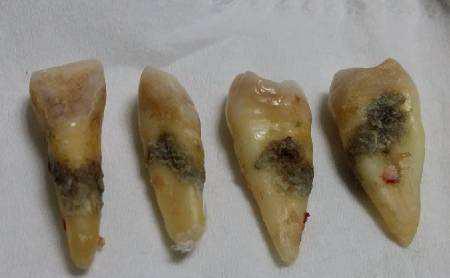 4岁孩子患上牙龈癌,只因奶奶经常给孩子喝它,不要给孩子买了