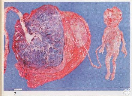 这样的情况在医学上被称为双胎输血综合征:两个胎儿血液循环出现问题