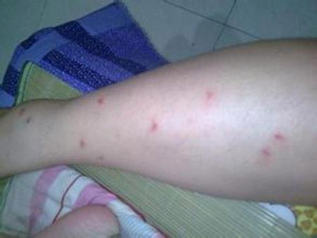 梅毒会导致皮肤上起疙瘩吗