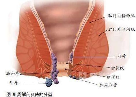 痔疮,行走,咳嗽,稍用力都可导致内痔脱出,用这5个窍门预防