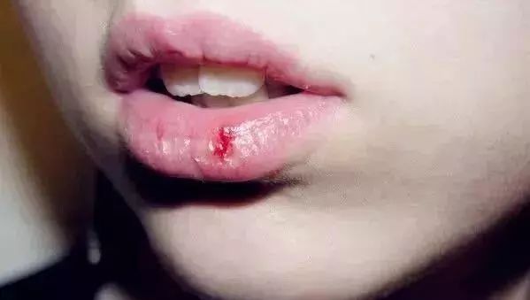 嘴唇干燥起皮居然也是病?这个大势男idol撕嘴皮遭粉丝狂劝.