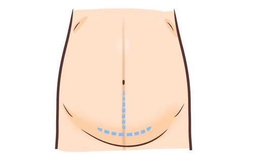 怀孕时肚皮上长"黑线",孕妈不用担心,不是妊娠纹