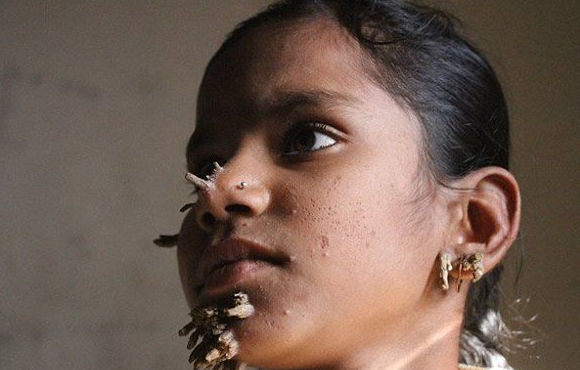 14岁女孩患怪病身上长树枝?父亲称担心孩子长大会没人娶!