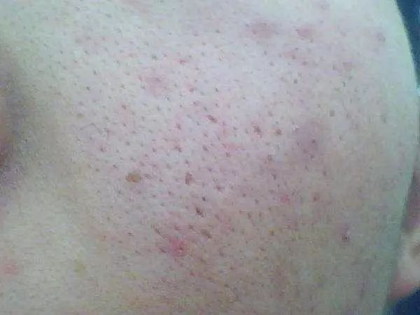 毛孔堵塞怎么办这些小妙招帮你疏通毛孔还你健康娇嫩肌肤