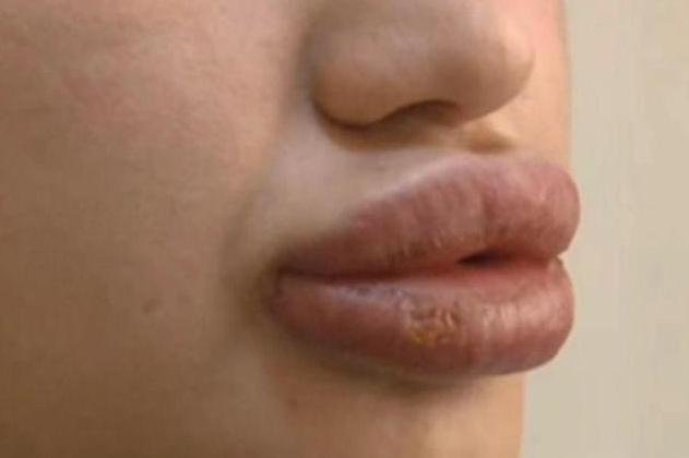 美女为了拥有性感迷人的嘴唇,去做了丰唇手术,手术后她却崩溃了